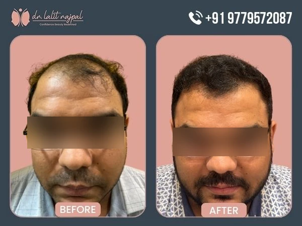 Before and after image of Hair Transplant Before and after image of Hair Transplant
