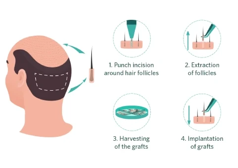 Follicular Unit Extraction (FUE)