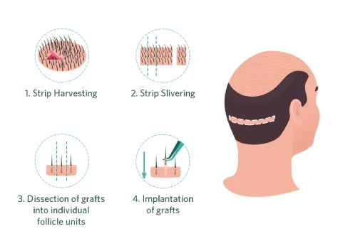 Follicular Unit Transplantation Follicular Unit Transplantation