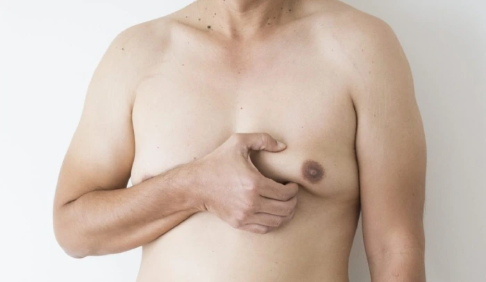 Gynecomastia Surgery Mumbai Gynecomastia Surgery in Mumbai