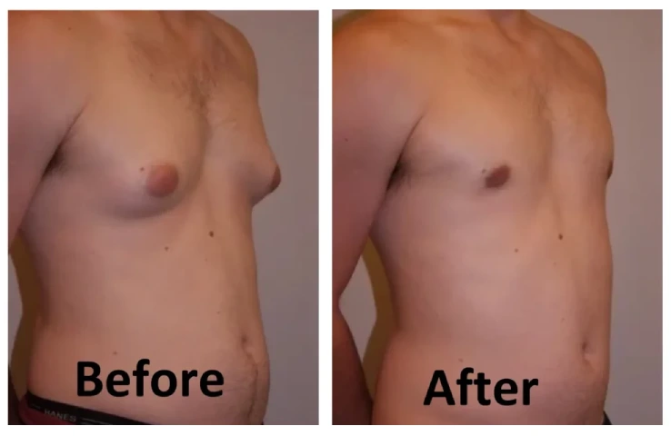 Gynecomastia before and after result image