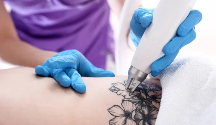 Laser Tattoo Removal in Mumbai