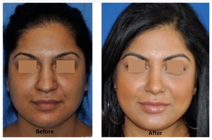 Rhinoplasty before and after image