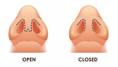 open rhinoplasty