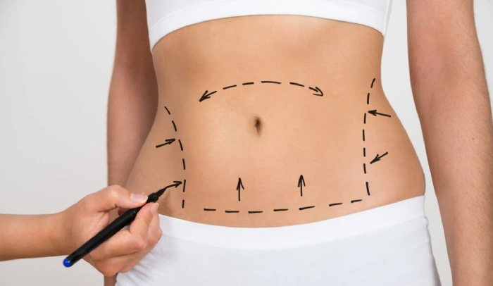 Tummy Tuck surgery in Mumbai