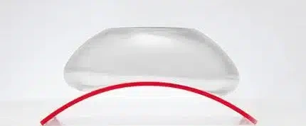 Structured Saline Breast Implants