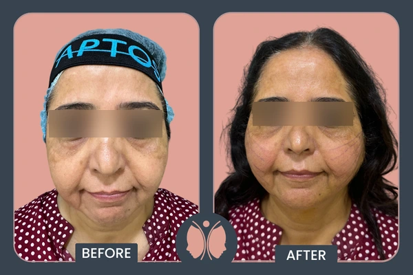 Threadlift after Result