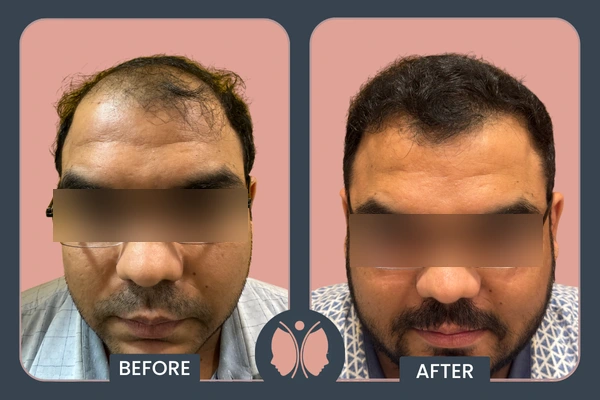 hair transplant result