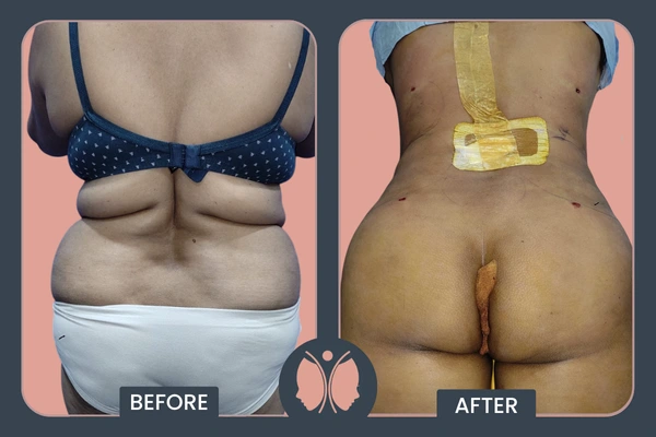liposuction before after image