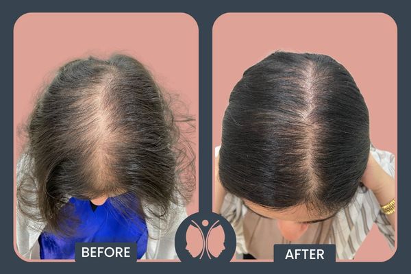 combination of Minoxidil and PRP sessions