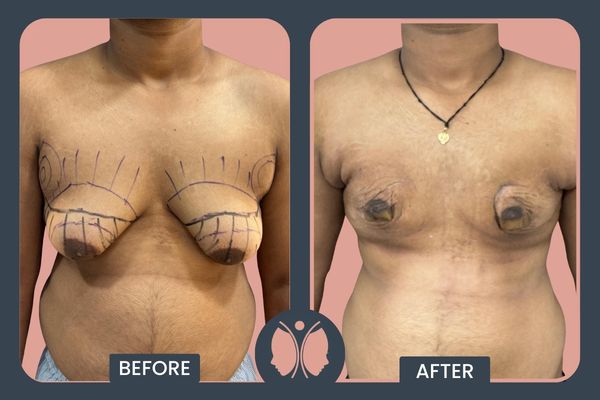 Gynecomastia Before and After Result