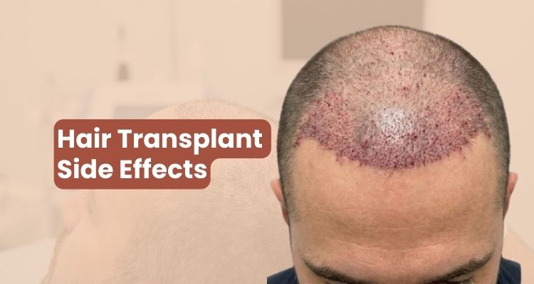 Hair Transplant Side Effects