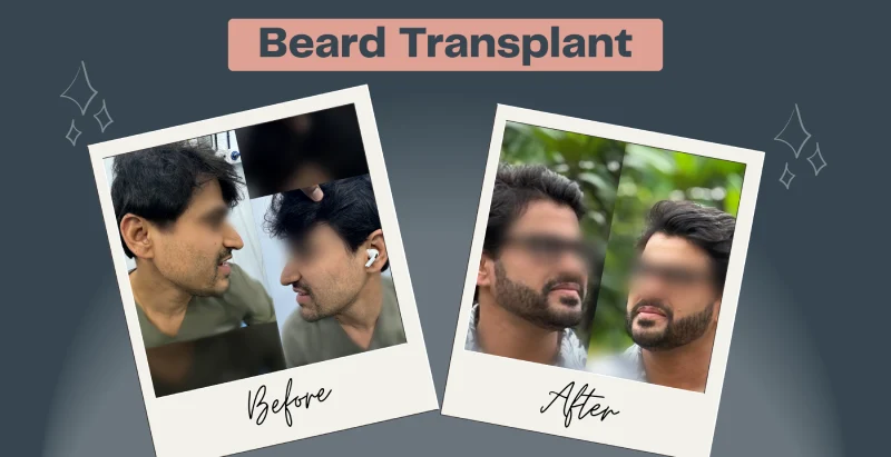 beard transplant before and after result