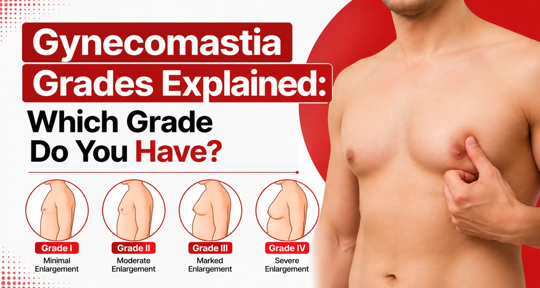Gynecomastia grades explained which grade do you have_