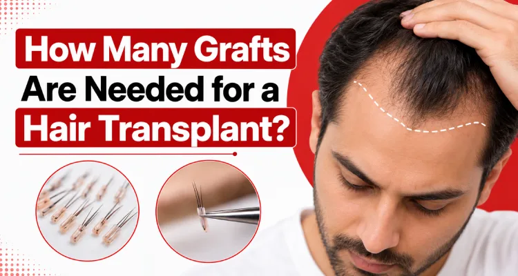 How Many Grafts Are Needed for a Hair Transplant?