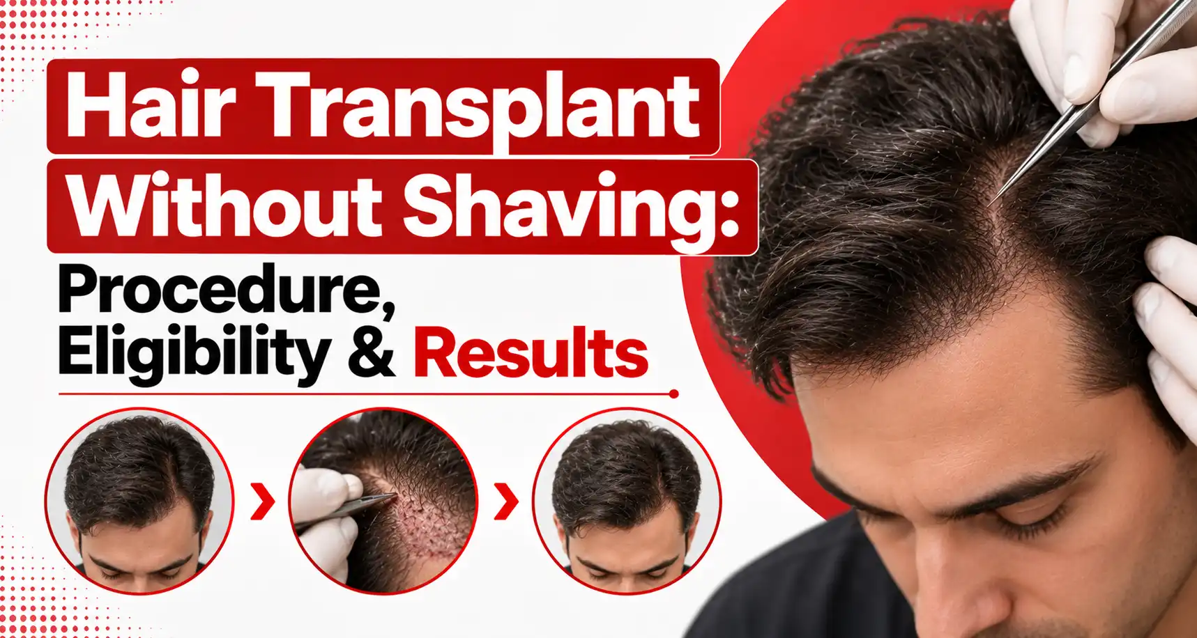 Hair Transplant Without Shaving: Is It Possible?