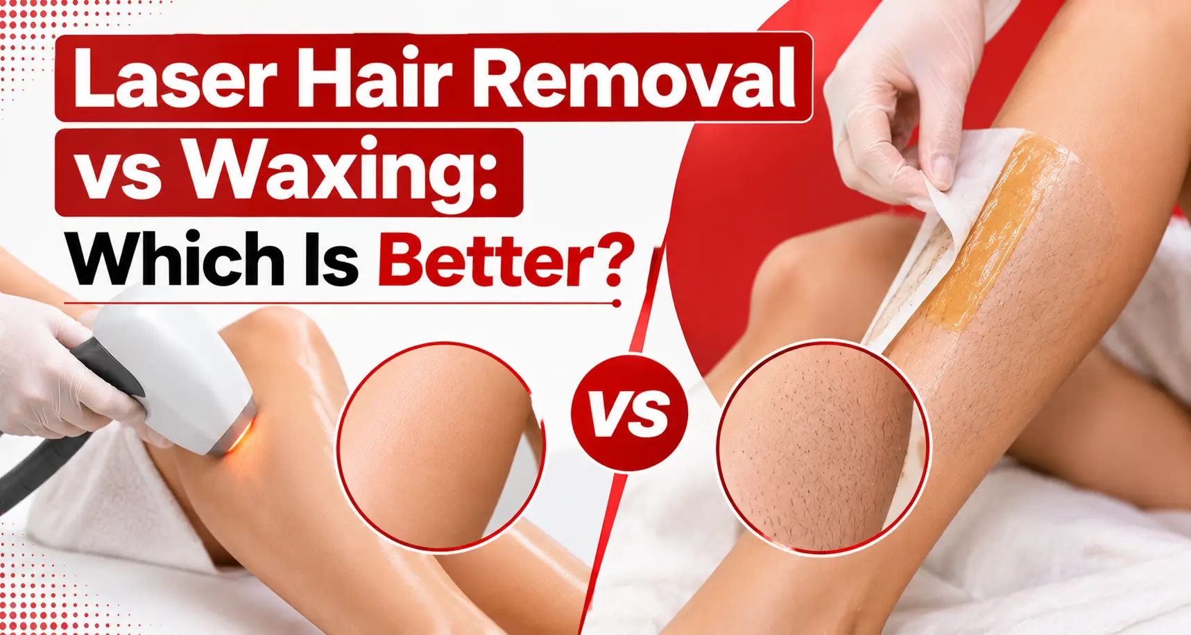 laser hair removal vs waxing